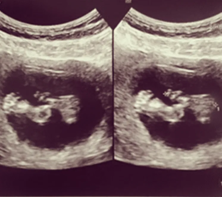 Zennube Ezgi’nin Hamilelik Günlüğü: 18.&19. Hafta